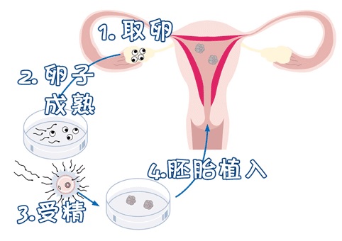 关于供精试管供卵中介